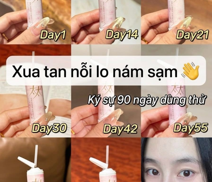 GÓC NHÌN ĐÔNG Y VỀ NÁM SẠM, DA SỈN MÀU Ở PHỤ NỮ